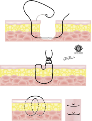 Bunnell suture (3) | definition of Bunnell suture (3) by ...